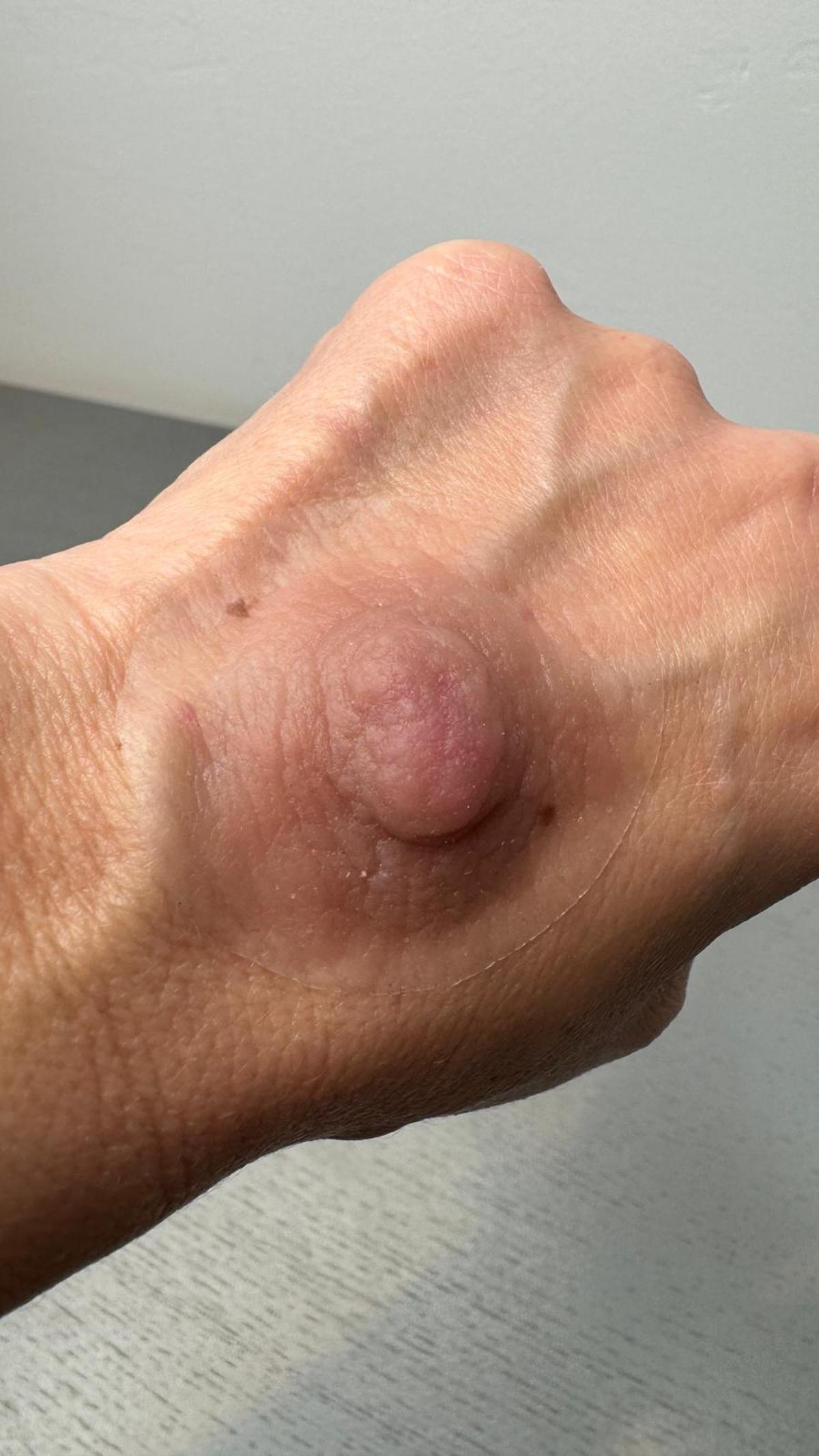 Prótesis de pezón artesanas.