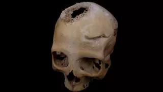 El paleopatólogo de la USC, Edgard Camarós, nos revela que los egipcios intentaron operar un tumor hace más de 4 mil años