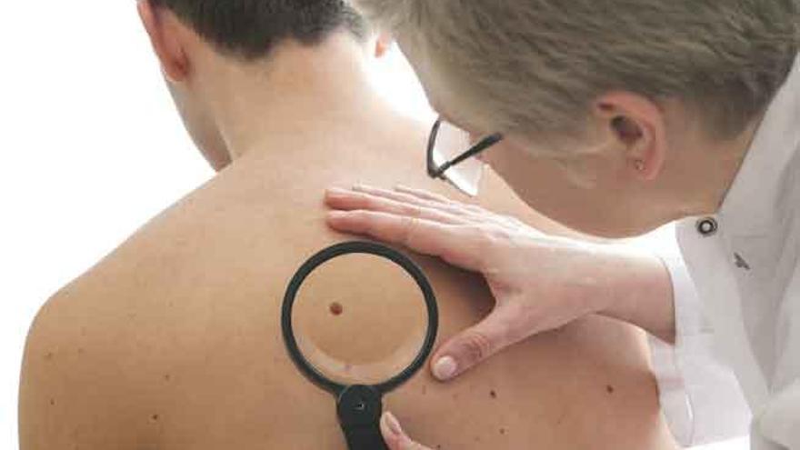 Un médico ausculta a un paciente con posible melanoma.