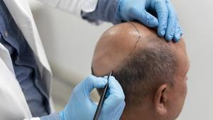 El injerto capilar es actualmente la única solución contra la alopecia
