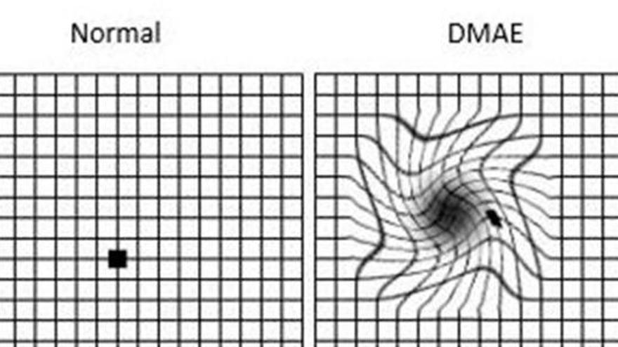 El test de la reixeta d&#039;Amsler és una forma ràpida i fàcil per avaluar la visió central de la retina