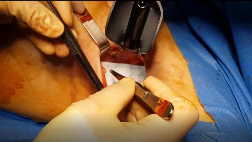 Cáncer Drenaje Linfatico Brazo Drenaje Linfatico Post Cirugia De