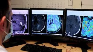 Una nueva herramienta basada en IA permite diferenciar entre tres tipos de tumores cerebrales