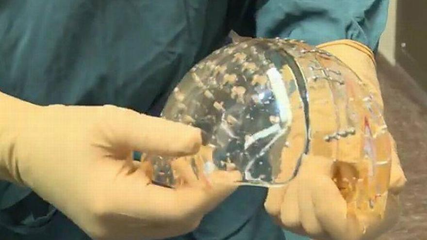 Implantado con éxito un cráneo de plástico hecho con una impresora 3D