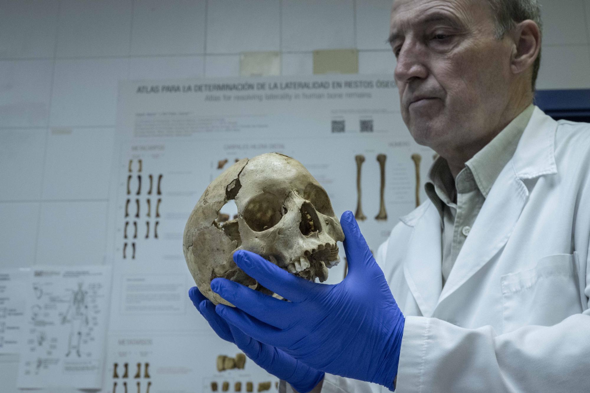 Cráneo de un menor asesinado en la Guerra Civil, independiente de la excavación de Celanova.