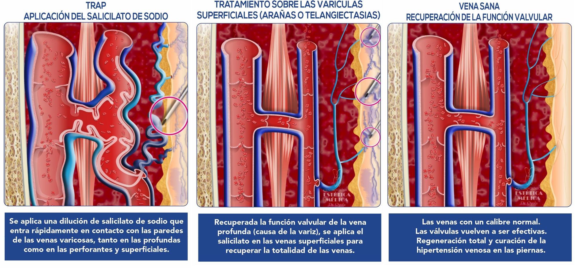 Adiós a las varices para siempre con la Fleboterapia Tridimensional  Regenerativa - El Periódico Extremadura