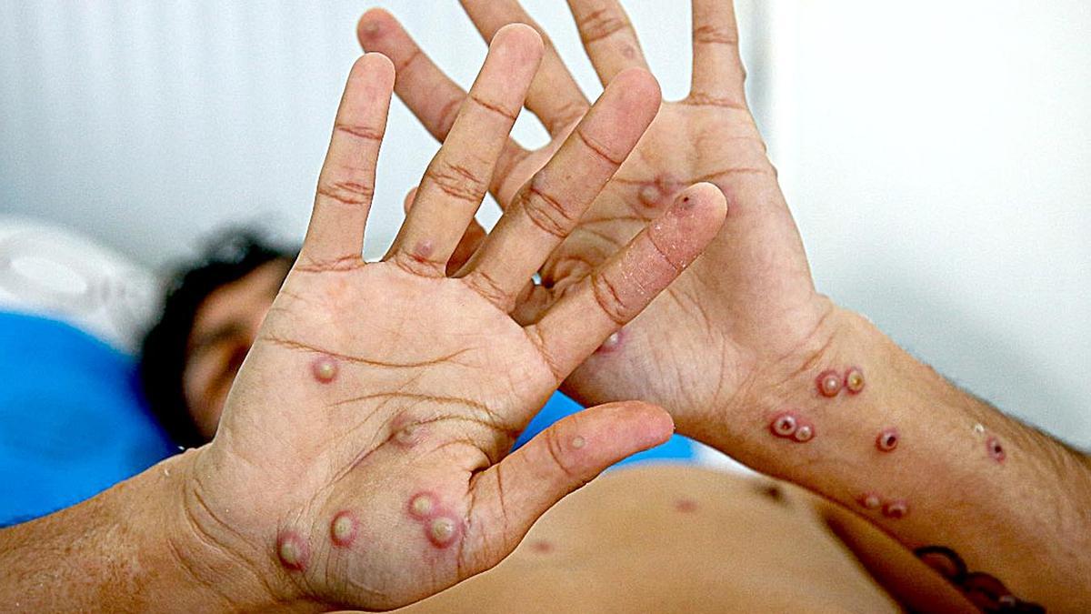 Un enfermo con viruela del mono.