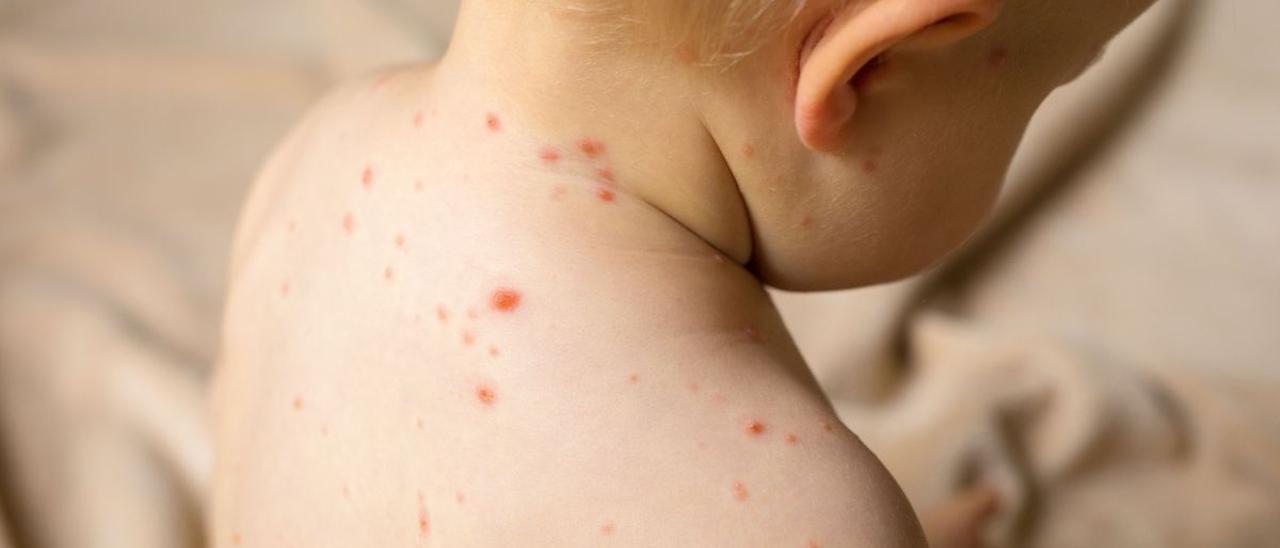 Un bebé con varicela, cuyas erupciones cutáneas se parecen a las de la gripe del tomate.