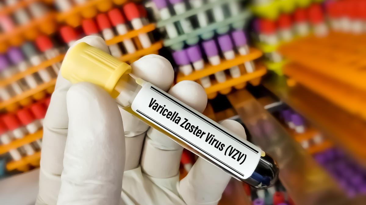Herpes zóster: así es la nueva vacuna contra el herpes zóster
