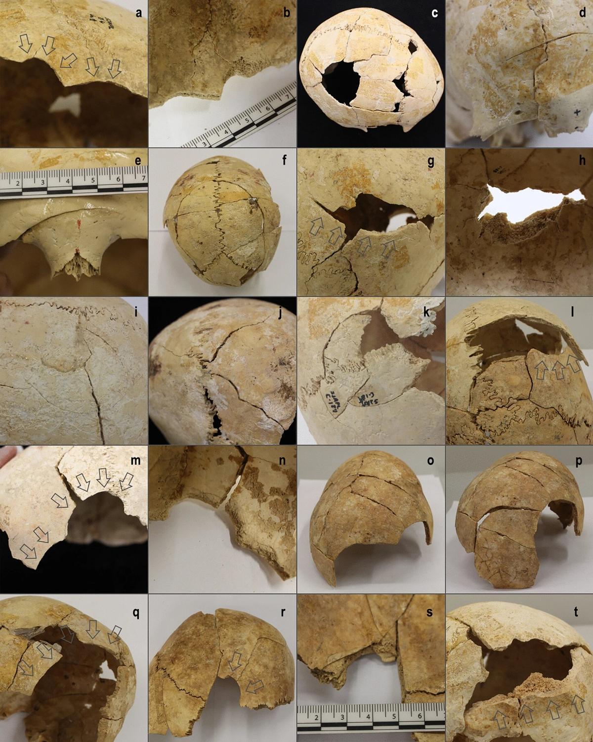 Ejemplos de lesiones de cráneo en los esqueletos de San Juan ante Portam Latinam, documentadas en el nuevo estudio.