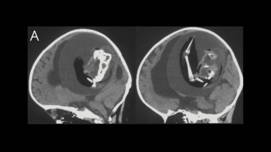 En las imágenes cerebrales de la niña de 1 año, los científicos pudieron apreciar una columna vertebral y otras estructuras óseas, pertenecientes al feto de su hermano, que no logró desarrollarse.