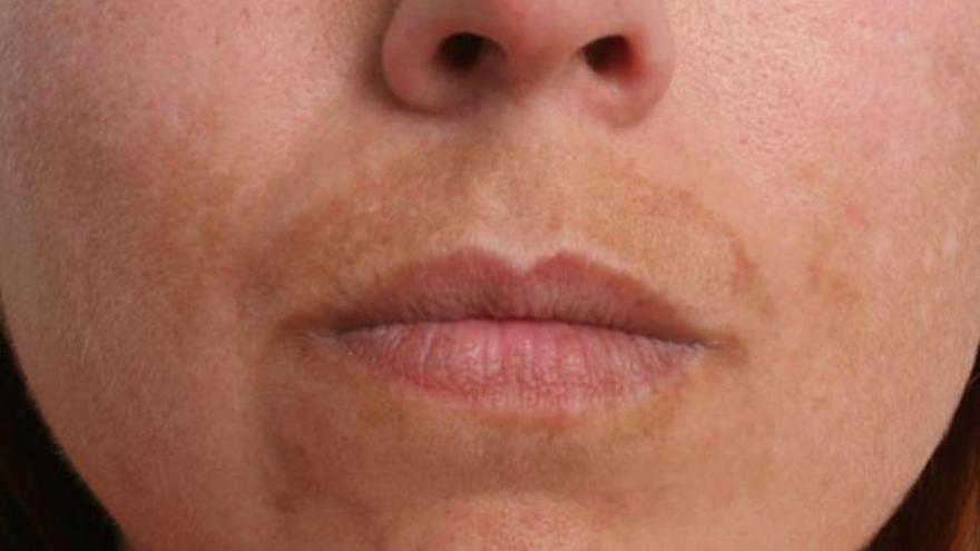 Leire Barrutia, dermatóloga: &quot;Para tratar el melasma, los cosméticos se quedan cortos y hay que recurrir a los despigmentantes médicos&quot;