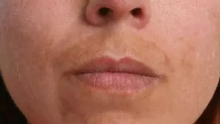 Leire Barrutia, dermatóloga: "Para tratar el melasma, los cosméticos se quedan cortos y hay que recurrir a los despigmentantes médicos"