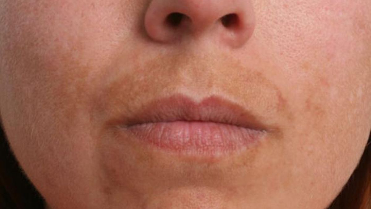 Cómo tratar el melasma