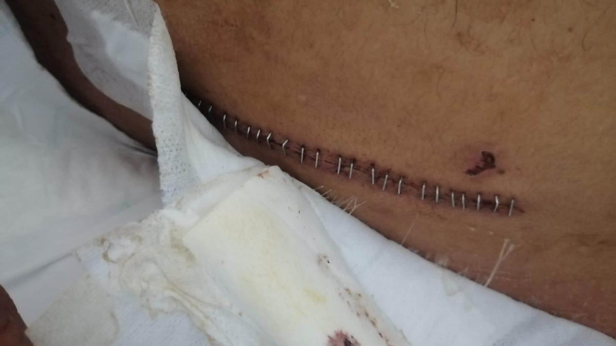 La cicatriz de la operación a la que fue sometido Diego en el Hospital General de Alicante Doctor Balmis.