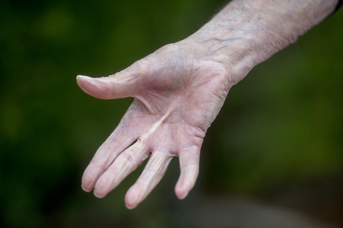 La mano de Rafael de Muller, con una contracción del tendón que le obliga a ampliar el ancho del mango de la raqueta. &quot;Me dicen de operar, pero a mi edad no lo veo claro&quot;