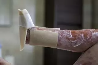 Vivir con piel de mariposa: "El dolor es insoportable"