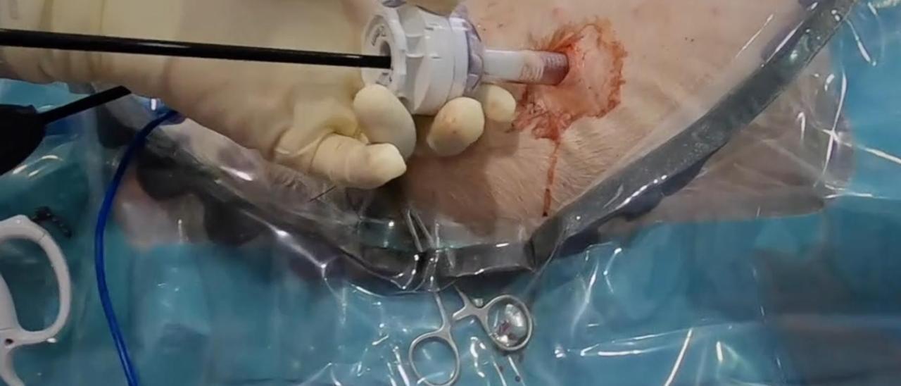 VÍDEO: El nuevo dispositivo desarrollado en Mallorca que revoluciona la cirugía por laparoscopia con un principio de la papiroflexia
