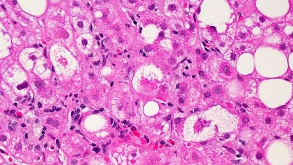 Una mujer sobrevive a 12 tumores, y ya es clave para investigar la cura contra el cáncer