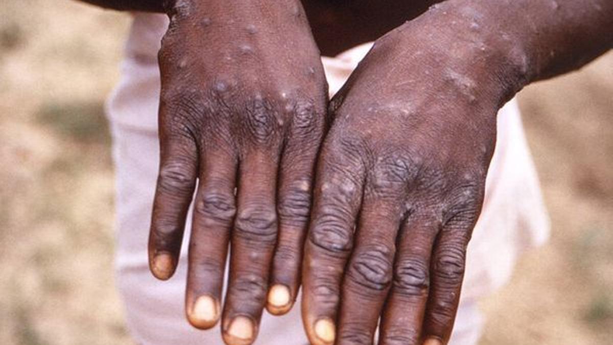 Dos manos de una persona contagiada por la viruela del mono.