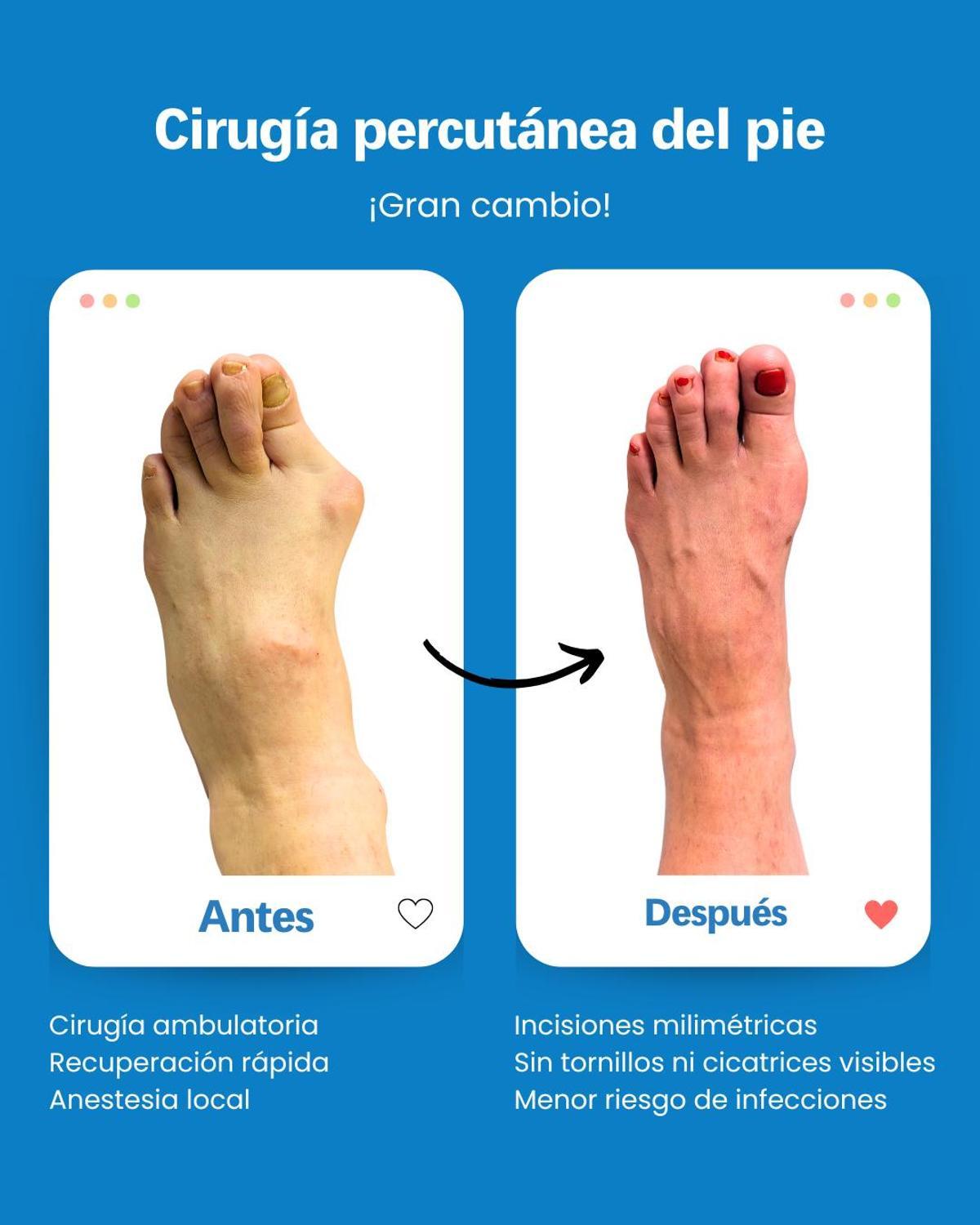 La cirugía mínima invasiva representa una revolución en el campo de la cirugía del pie