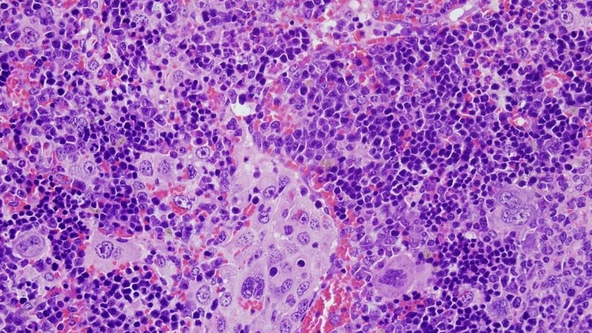 Identifican mutaciones vinculadas al desarrollo de tumores en la sangre