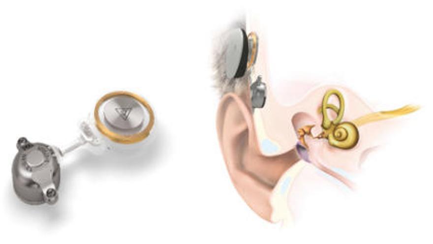 Imagen de la tecnología que se implantará hoy en Povisa a un paciente con problemas de audición.