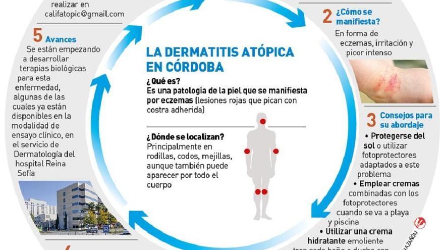 Más niños con dermatitis atópica