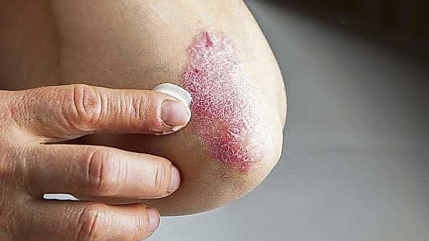 Una persona con psoriasis se echa una crema.