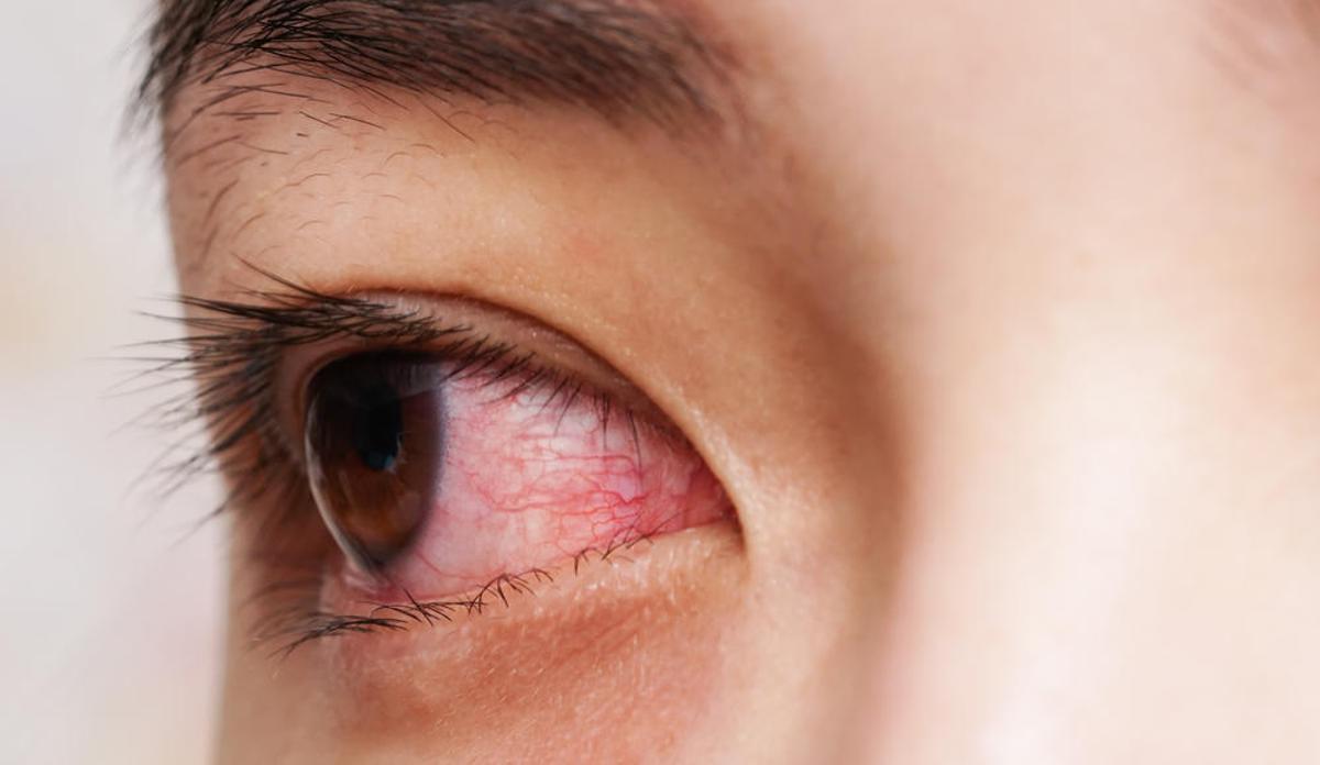 Mujer con conjuntivitis.