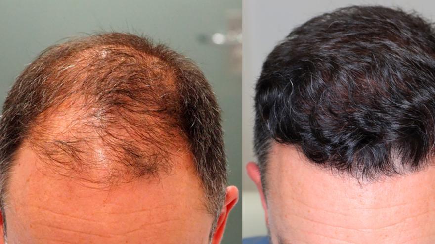 Muere en Estambul antes de someterse a un injerto capilar: investigan posible negligencia médica