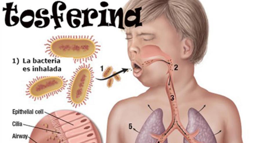 Infografía sobre la tosferina