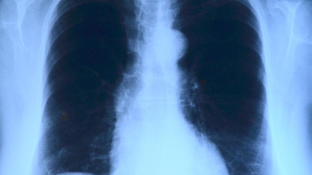 Las infecciones pulmonares bacterianas son uno de los principales factores de riesgo en las gripes.