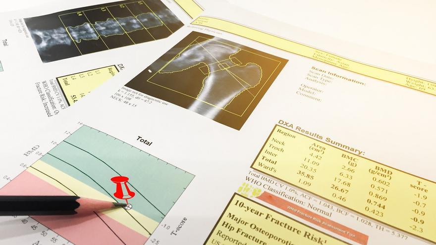 La osteoporosis provocada por el tratamiento del cáncer de mama se puede prevenir