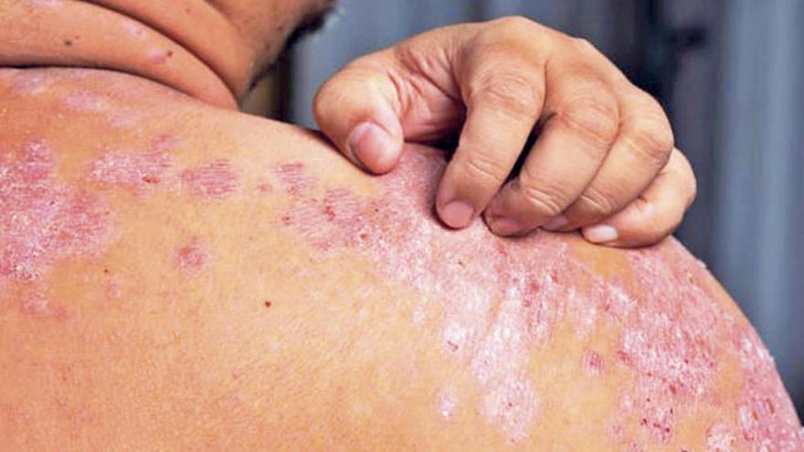 Un paciente afectado por la psoriasis.