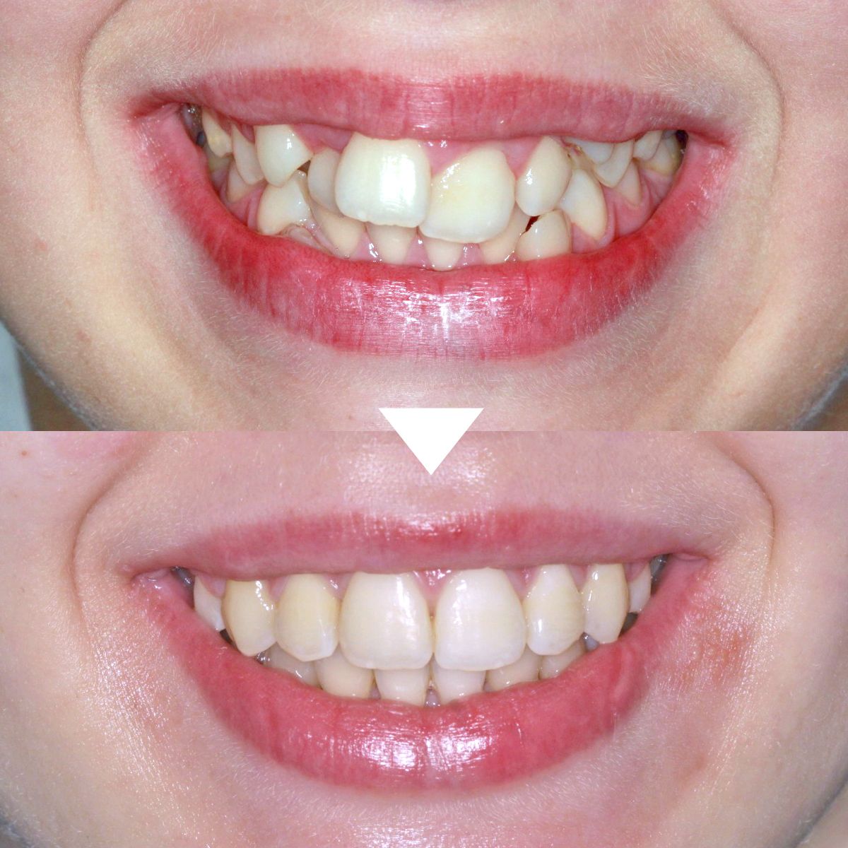 Ortodoncia antes y después.