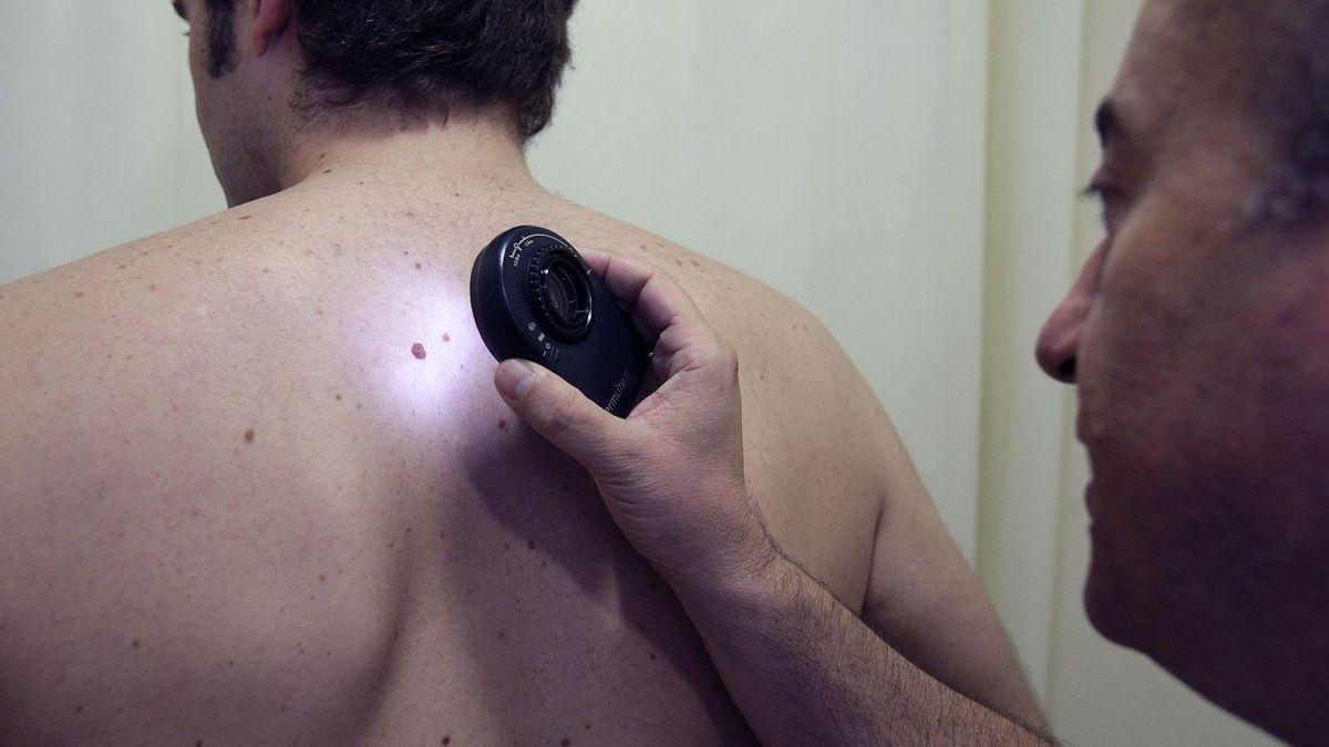 Un dermatólogo revisa los lunares y manchas de un paciente