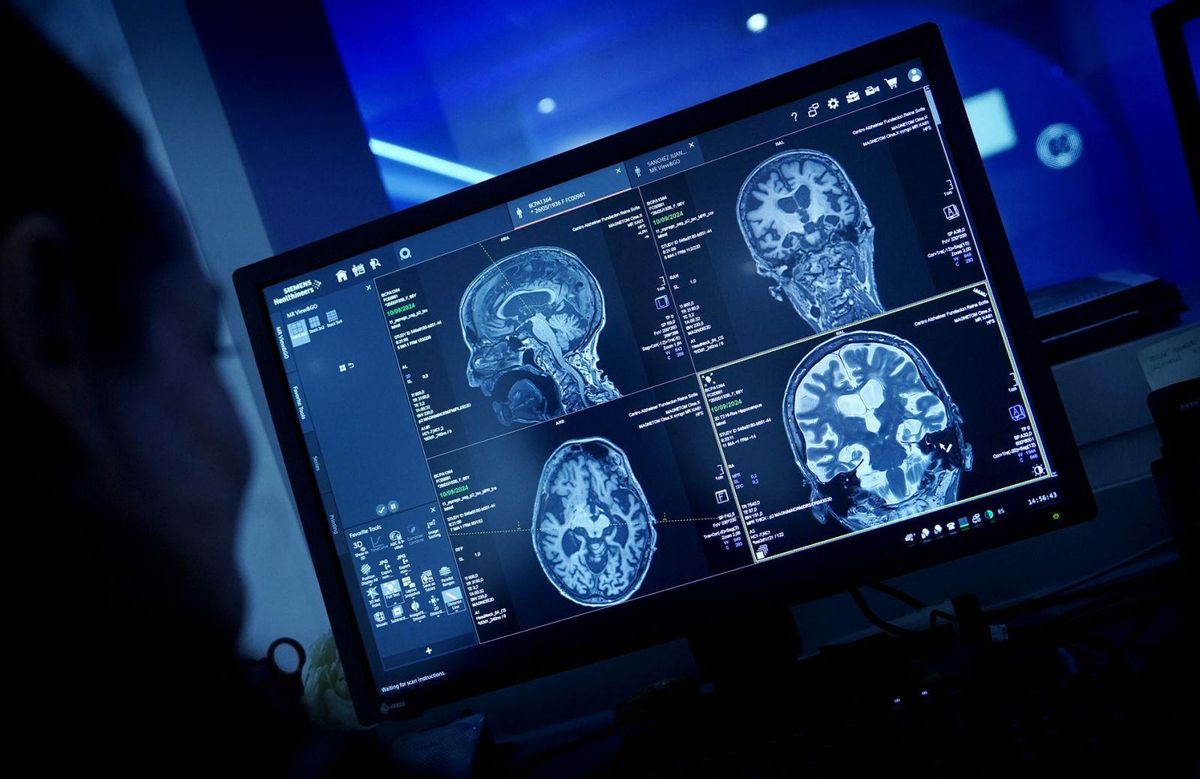 Un estudi qüestiona que tenir estudis "protegeixi" de l’Alzheimer Un estudi qüestiona que tenir estudis "protegeixi" de l’Alzheimer