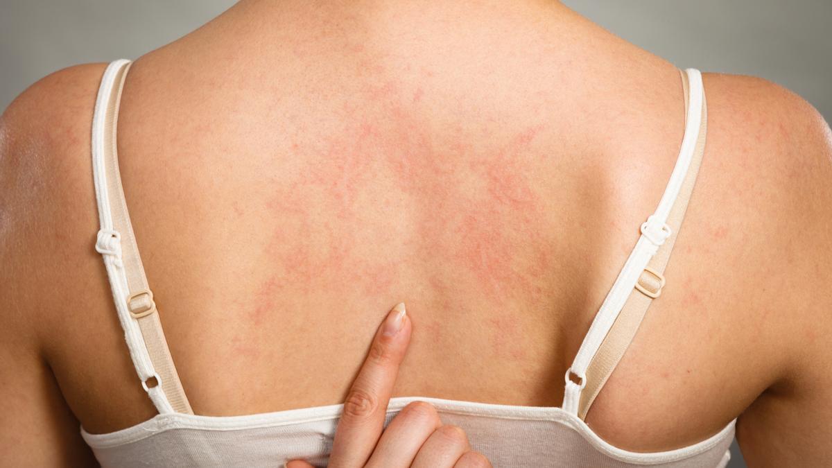 Urticaria provocada por una reacción alérgica.