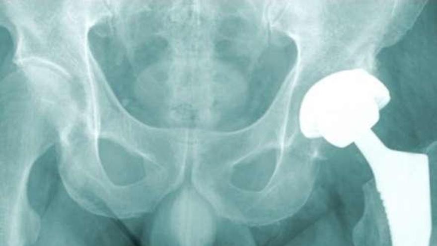 Radiografía de una prótesis de cadera. // FdV