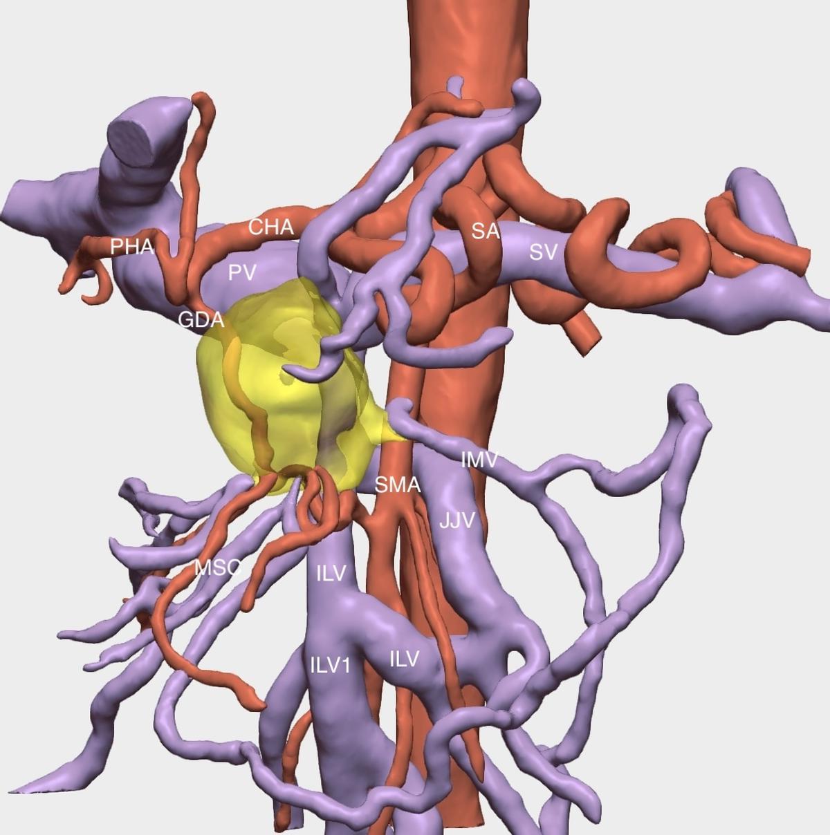 Reconstrucción del tumor de páncreas en tres dimensiones