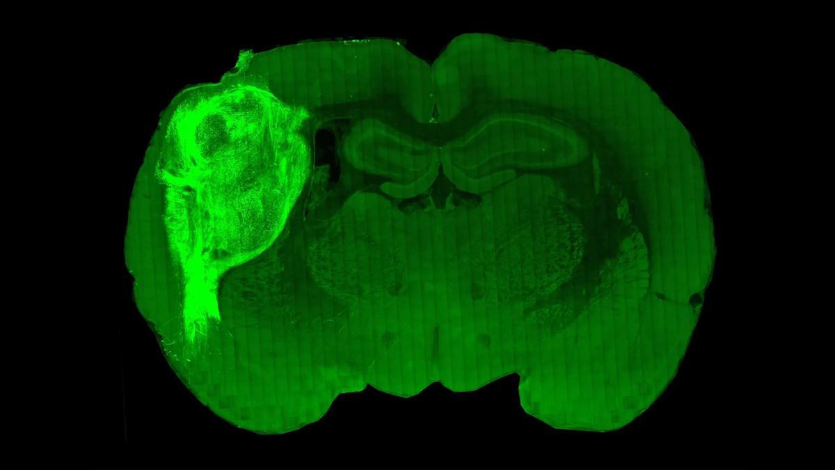 Una sección transversal del cerebro de una rata de laboratorio revela el extenso crecimiento de un organoide de cerebro humano (área brillante a la izquierda) trasplantado en él.