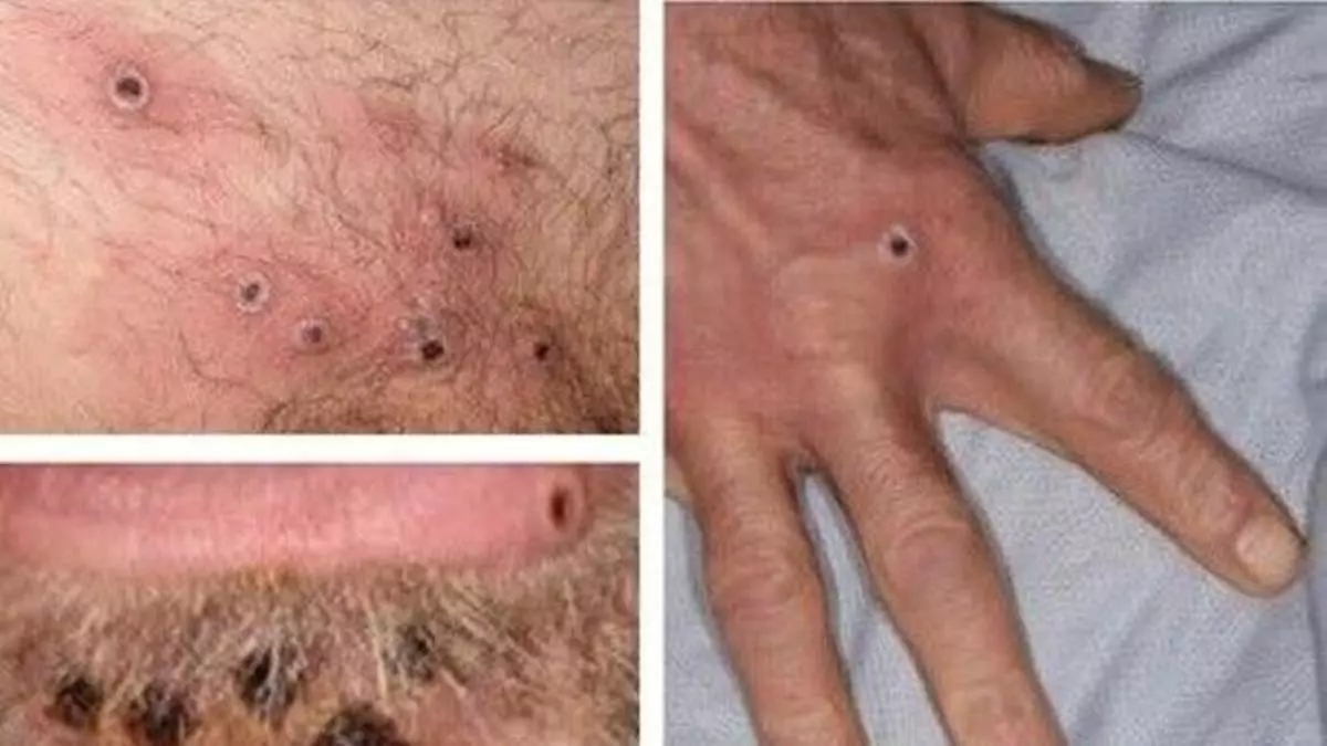 Viruela del mono: cuáles son sus síntomas y cuándo pueden aparecer complicaciones