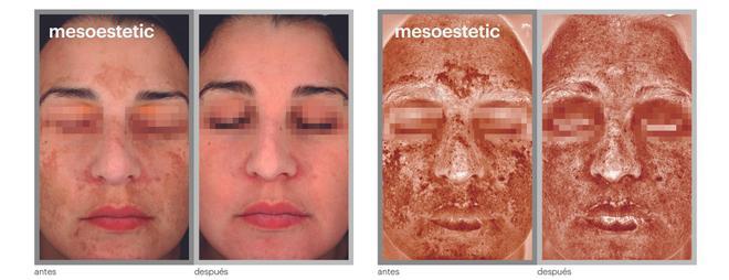 Antes y después tras el tratamiento cosmelan® de Mesoestetic®.
