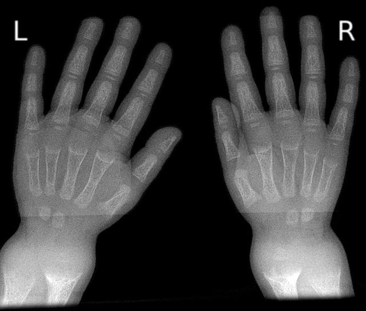 El tratamiento de la XLH, hasta ahora, eran suplementos de vitamina D y cirugía ortopédica