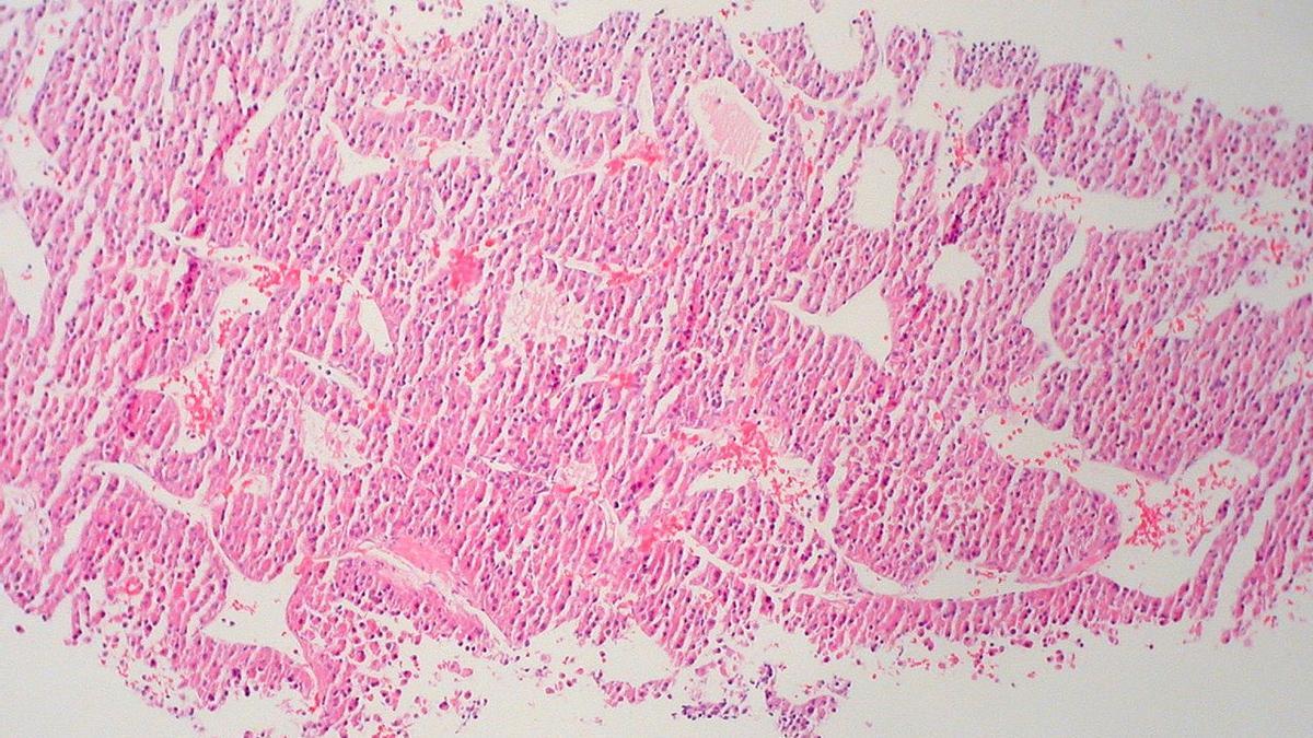 Carcinoma Hepatocellular