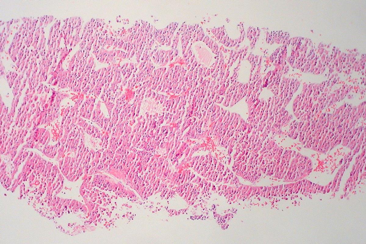 Carcinoma Hepatocellular
