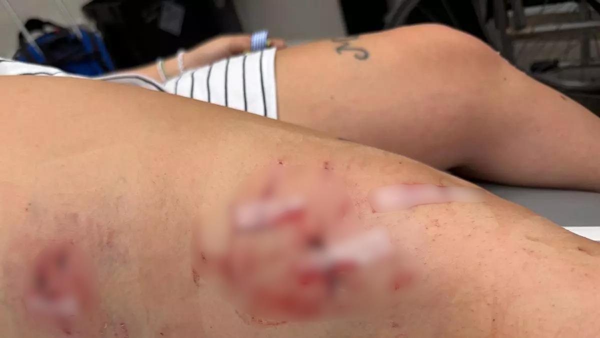 Las heridas en la pierna derecha de la joven, donde la atacó brutalmente el mastín.