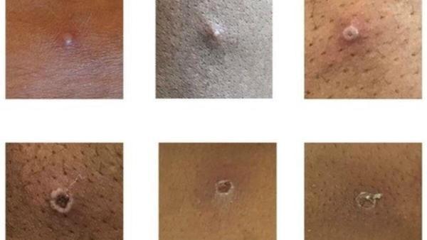 Temas Que Es Exantema Vesicular Último Temas Que Es Exantema Vesicular Último