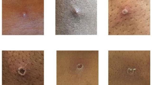 Exantema vesicular, el síntoma más evidente de la viruela del mono: ¿Qué es y cuáles son sus síntomas?
